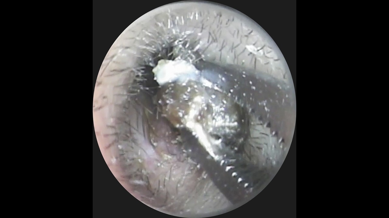 Vol.340【耳掃除】2年ブリのご来店　奥まで押し込まれた耳垢を救出！