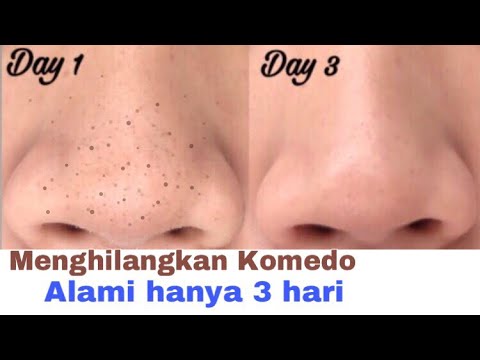 download lagu mp3 mp4 Cara Menghilangkan Komedo Terampuh, download lagu Cara Menghilangkan Komedo Terampuh gratis, unduh video klip Cara Menghilangkan Komedo Terampuh