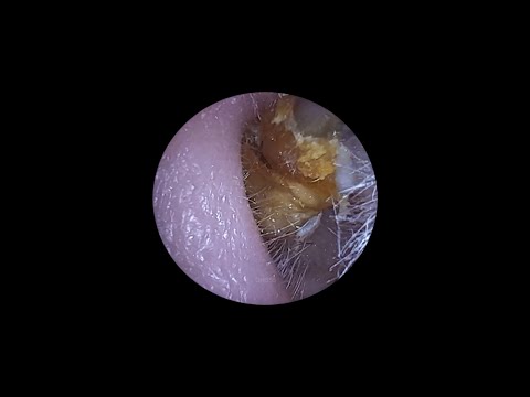 Large Ear Wax Chunks Extracted with Suction and Rosen Inserter.
