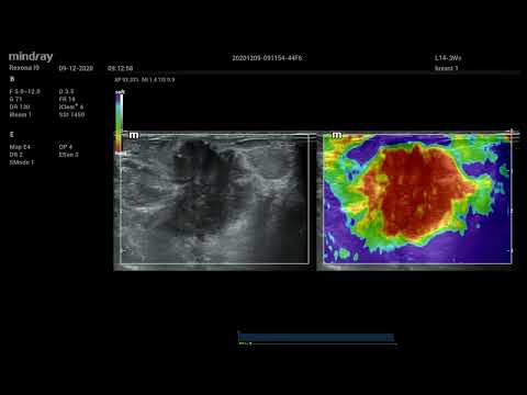 Natural Touch Elastography Natural Touch Elastography