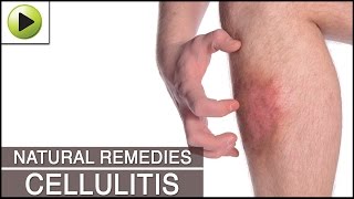 Home Remedies for Cellulitis