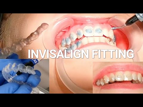 Invisalign Braces Fitting Appointment - Orthodontist Explains Each Step! (Including Attachments)