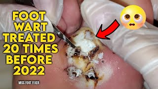 BIGGEST FOOT WART EVER??? [TREATED 20 TIMES BEFORE ] BY MISS FOOT FIXER