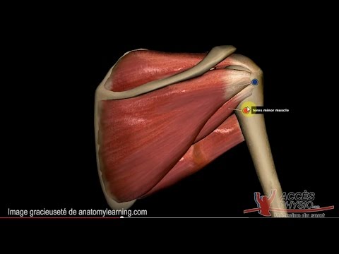 comment soulager calcification épaule