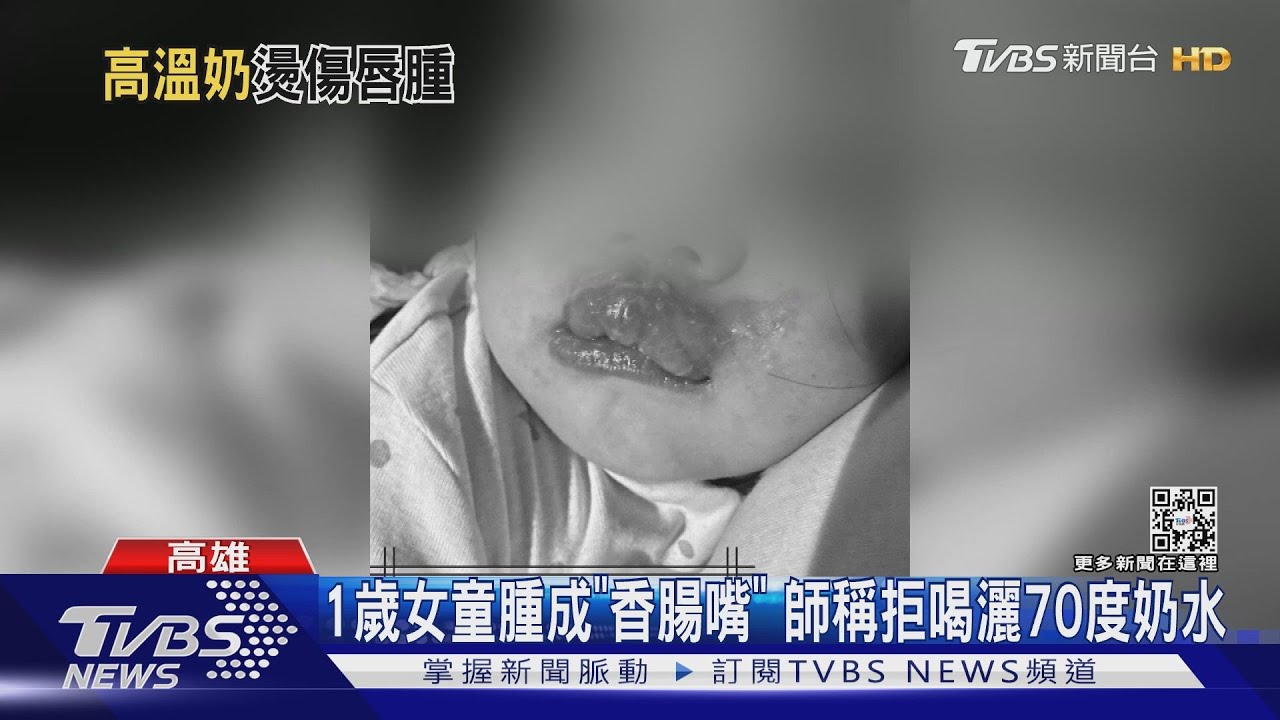 高雄1歲女童腫成「香腸嘴」母提告 師稱拒喝奶灑70度奶水