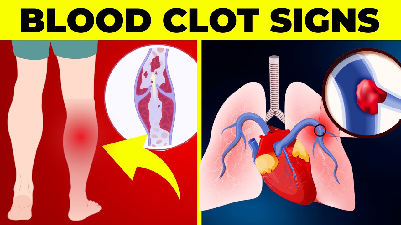 7 Signs Of A Blood Clot You Should NEVER Ignore
