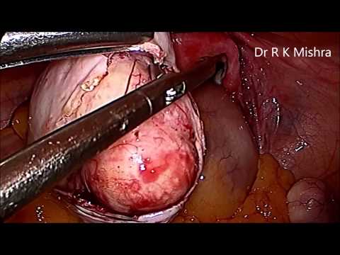 Cista na jajniku cista na jajniku