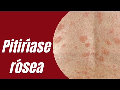 Pitiríase rósea | Causas | Sintomas | Tratamentos | Casos graves