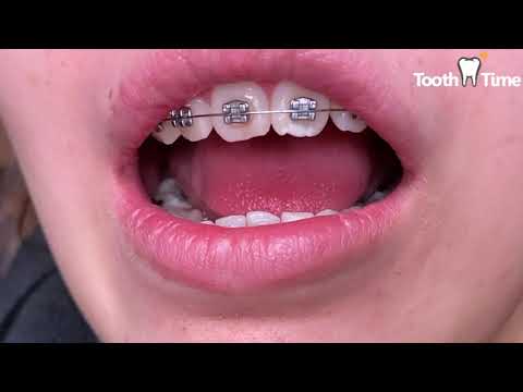 Braces Checkups - Coil spring off - Changing wire 016 Niti to 18x25 Niti - ToothTime New Braunfels