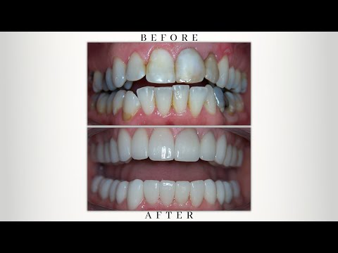Before & After Smile Gallery by Scottsdale Cosmetic Dentistry Excellence
