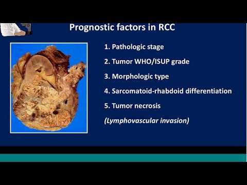 CAP education session Kidney cancer Dr Trpkov 2018