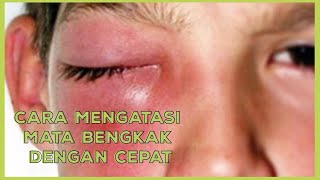 Download lagu Mata Memerah dan Bengkak ?? Begini Cara Mengobati Mata Bengkak ! mp3 Download lagu Mata Memerah dan Bengkak ?? Begini Cara Mengobati Mata Bengkak ! mp3