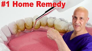 #1 Home Remedy to Remove Dental Plaque & Tarter to Prevent Cavities | Dr. Mandell