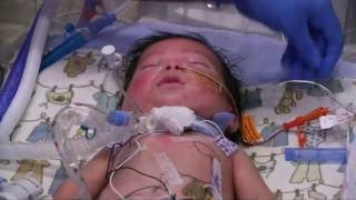 Managing Risks for Premature Babies