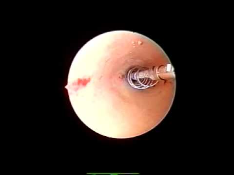 Giunti iniezione Ostenil Pressurizzazione da osteocondrosi