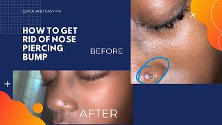 HOW TO GET RID OF NOSE PIERCING BUMP ( 5 min fix)