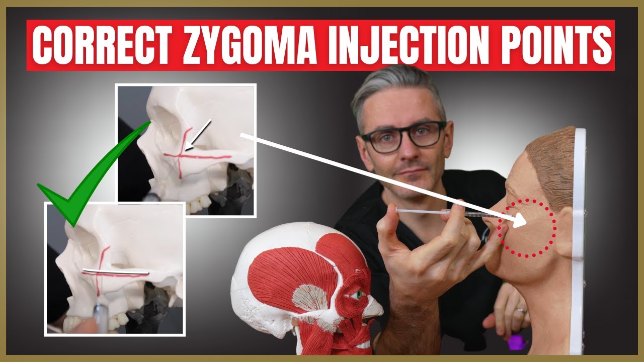 Injecting the Zygoma | Safety Advice & Injection Points