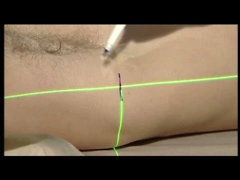 Cancer påverkar mäns fertilitet - Nyheterna (TV4)