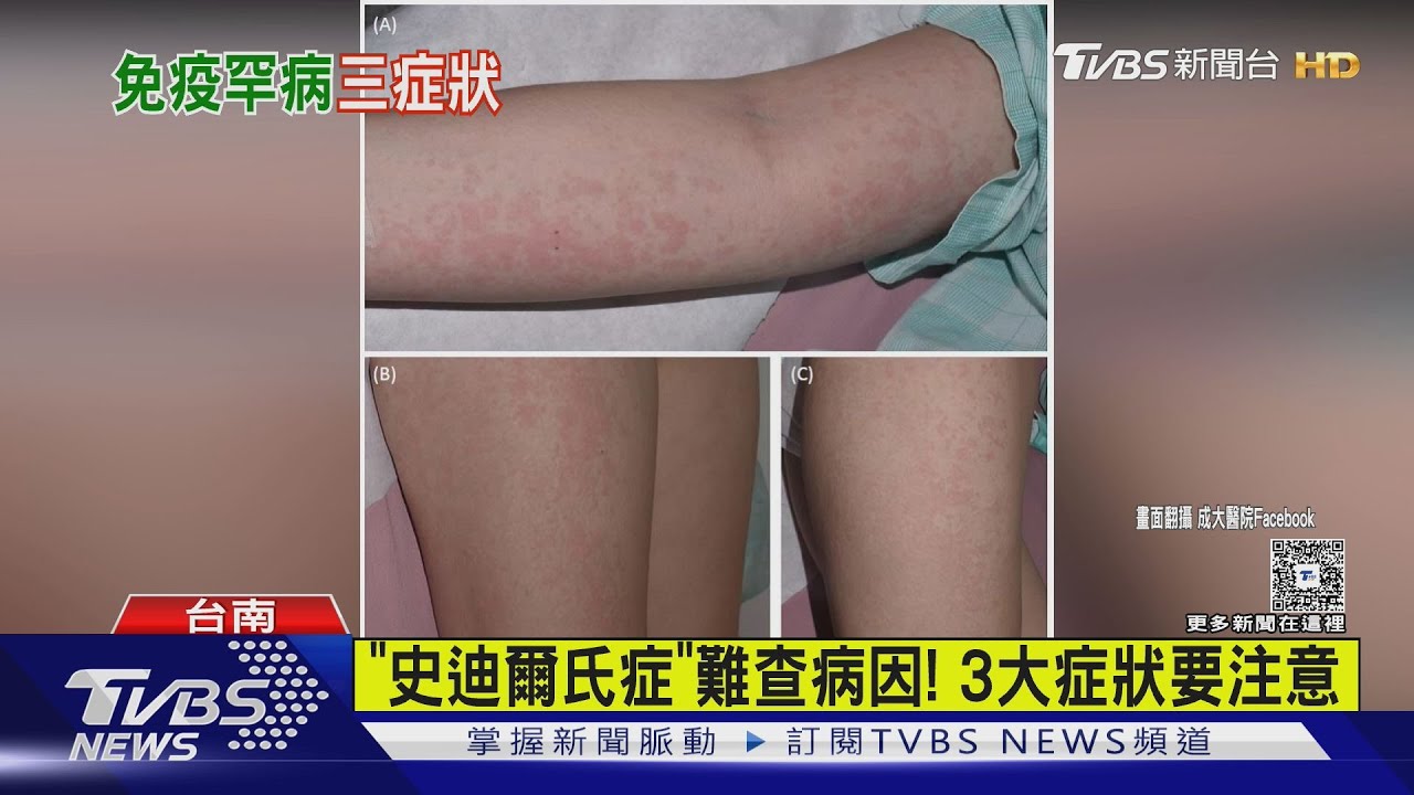 長榮空服員疑罹患「史迪爾氏症」 醫師曝:恐成免疫風暴