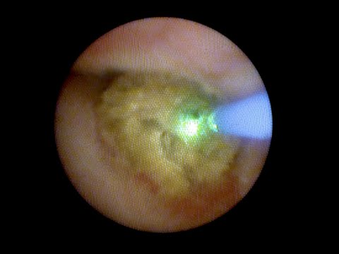 REVOLIX HTL URETERAL STONE