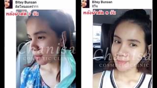 คุณใบเตยกับงานแก้ไข คางที่เคยเลาะซิลิโคนเหลวจาก ที่อื่นแล้วมีปัญหา คุณใบเตยกับงานแก้ไข คางที่เคยเลาะซิลิโคนเหลวจาก ที่อื่นแล้วมีปัญหา