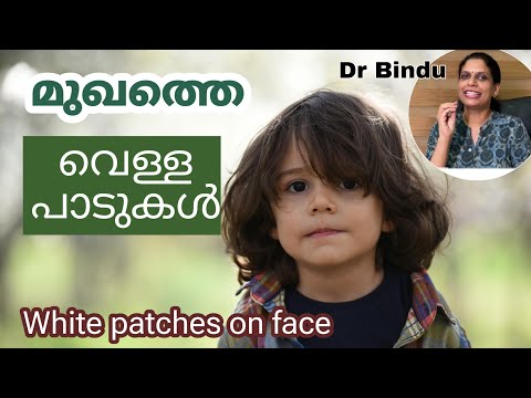 White patches over face in children Dr Bindu
