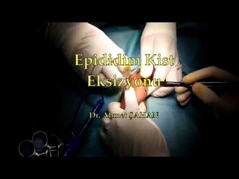 download lagu mp3 mp4 Epididim Kisti, download lagu Epididim Kisti gratis, unduh video klip Epididim Kisti