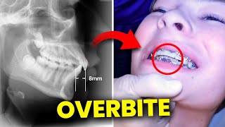 Excessive OVERBITE Correction without Surgery....Orthodontist