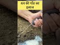 थन की गाँठ का इलाज L Dr Umar Khan