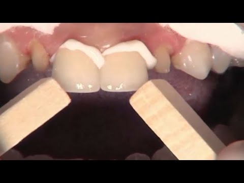 Use of Clinical Zirconia Crowns & No Prep Veneers for Esthetic Enhancement