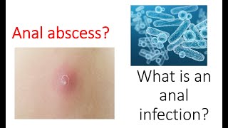 Infection in your anus What is a rectal or anal abscess Learn from an expert!