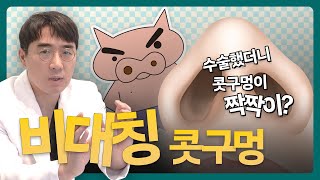 콧구멍 비대칭 원인·교정·재수술 Q&Aㅣ비티성형외과