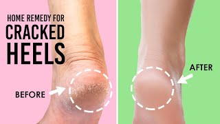 फटी एड़िया से छुटकारा पाए | Home Remedy For Cracked Heels In Hindi | Winter Skincare | Be Beautiful