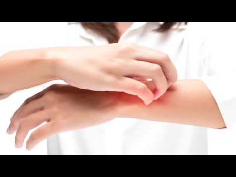 Trattamento di heylit a dermatite atopic Leczema come conservarsi su sempre