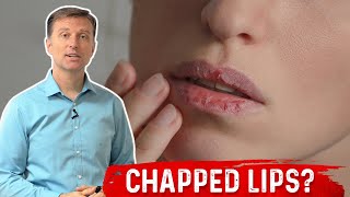 Which Vitamin Deficiency Causes Chapped / Cracked Lips? – Dr. Berg