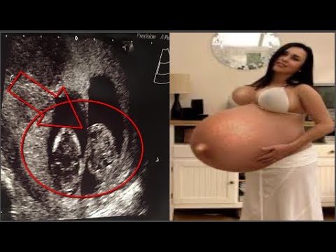 Elle soupçonne une chose bizarre pendant sa grossesse et 40 médecins assistent son accouchement Video