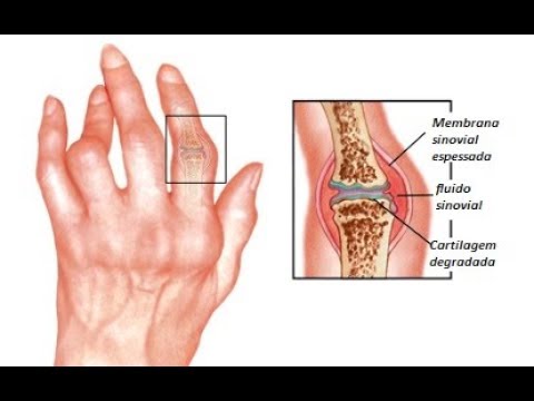Infiammazione delle articolazioni nome della malattia Se è possibile camminare in osteocondrosi in una sedia a dondolo