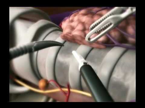 dVT  Animated Overview 2  Surgical Steps   Chung 870420