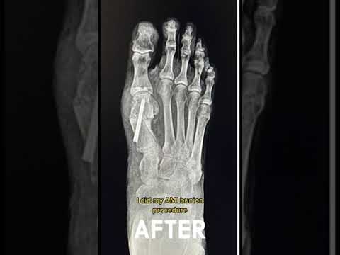 Bunion's Extreme Makeover: See What Happens Next?
