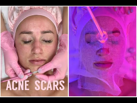 Acne Scar Resurfacing & Enzyme Tightening Facial | Jadeywadey180