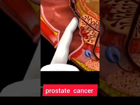 PROSTATE  CANCER  || PROSTATE CANCER ANIMATION  #howtogetsuccessinlife #biologyislife #getsuccess