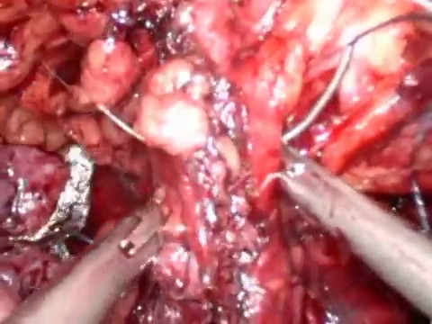 Prostatite e metodi di trattamento Immagini della prostata con un massaggio dito
