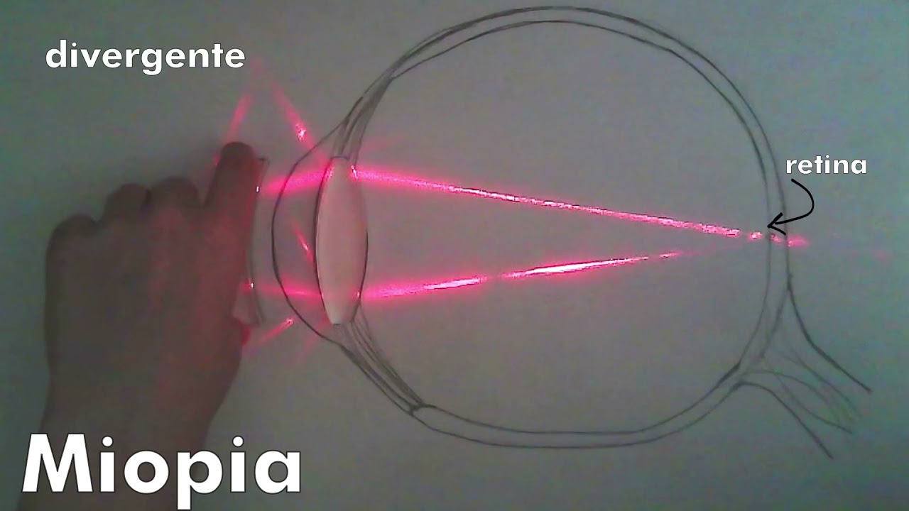 Lente convergente e divergente - Problemas de visão - Ciências