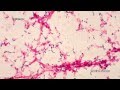 Bacterial Meningitis - YouTube
