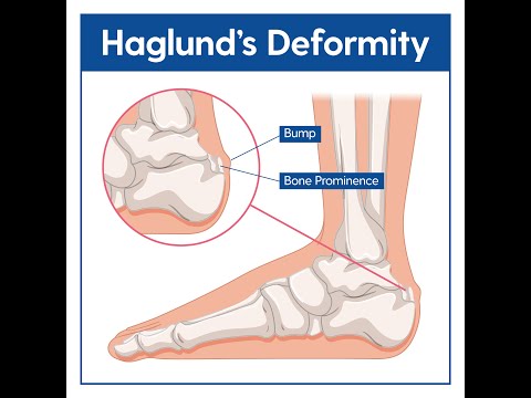 Haglund’s Deformity or pump bump on the back of the heel bone (calcaneus) ; Causes, Symptoms, Treat