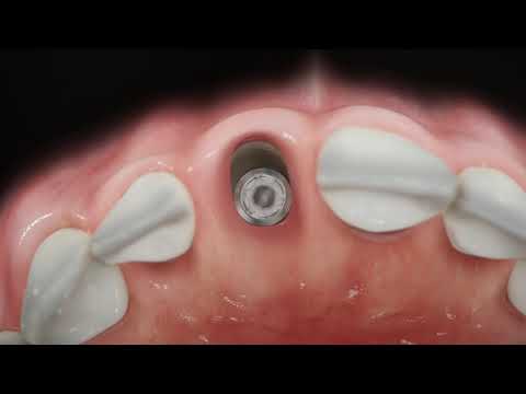 Straumann® BLX - Immediate anterior implant placement