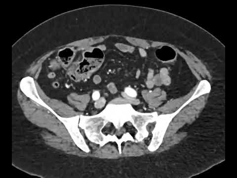 How to find the appendix on CT
