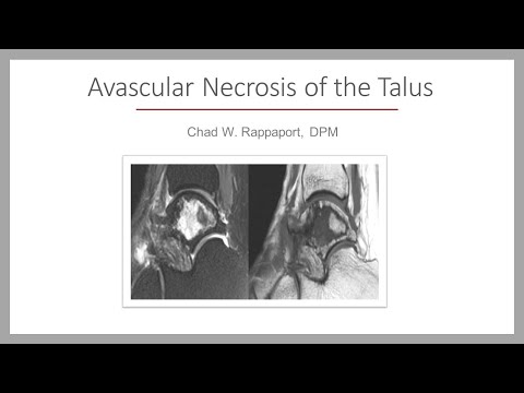Avascular Necrosis of the Talus