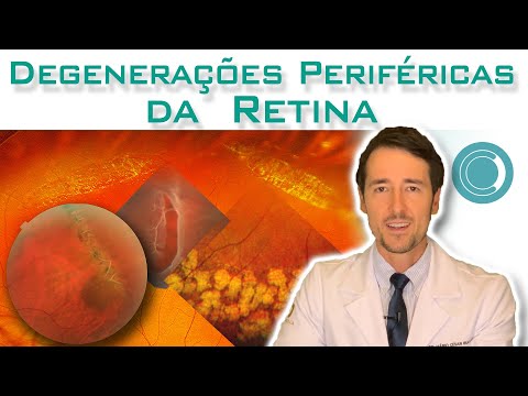 Degenerações Periféricas da Retina e o Descolamento de Retina