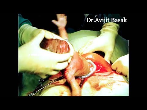 Cesarean Section Under Local Anaesthesia